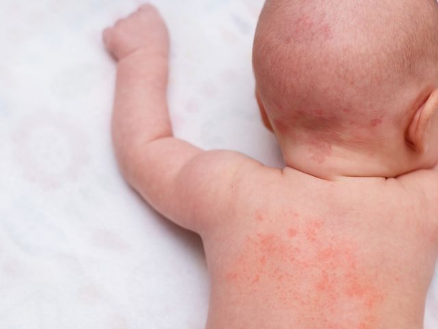 Gambar Alergi Pada Anak