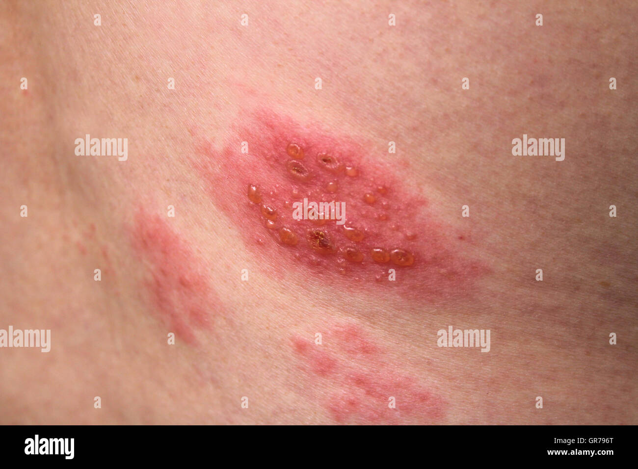 Gambar Herpes Zoster