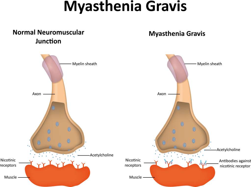 Gambar Penyakit Myasthenia Gravis